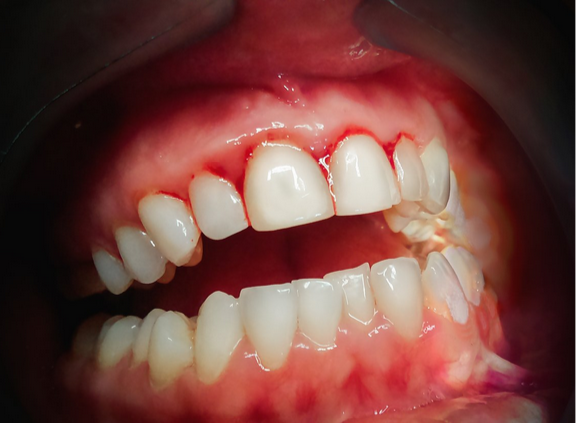 أمراض اللثة